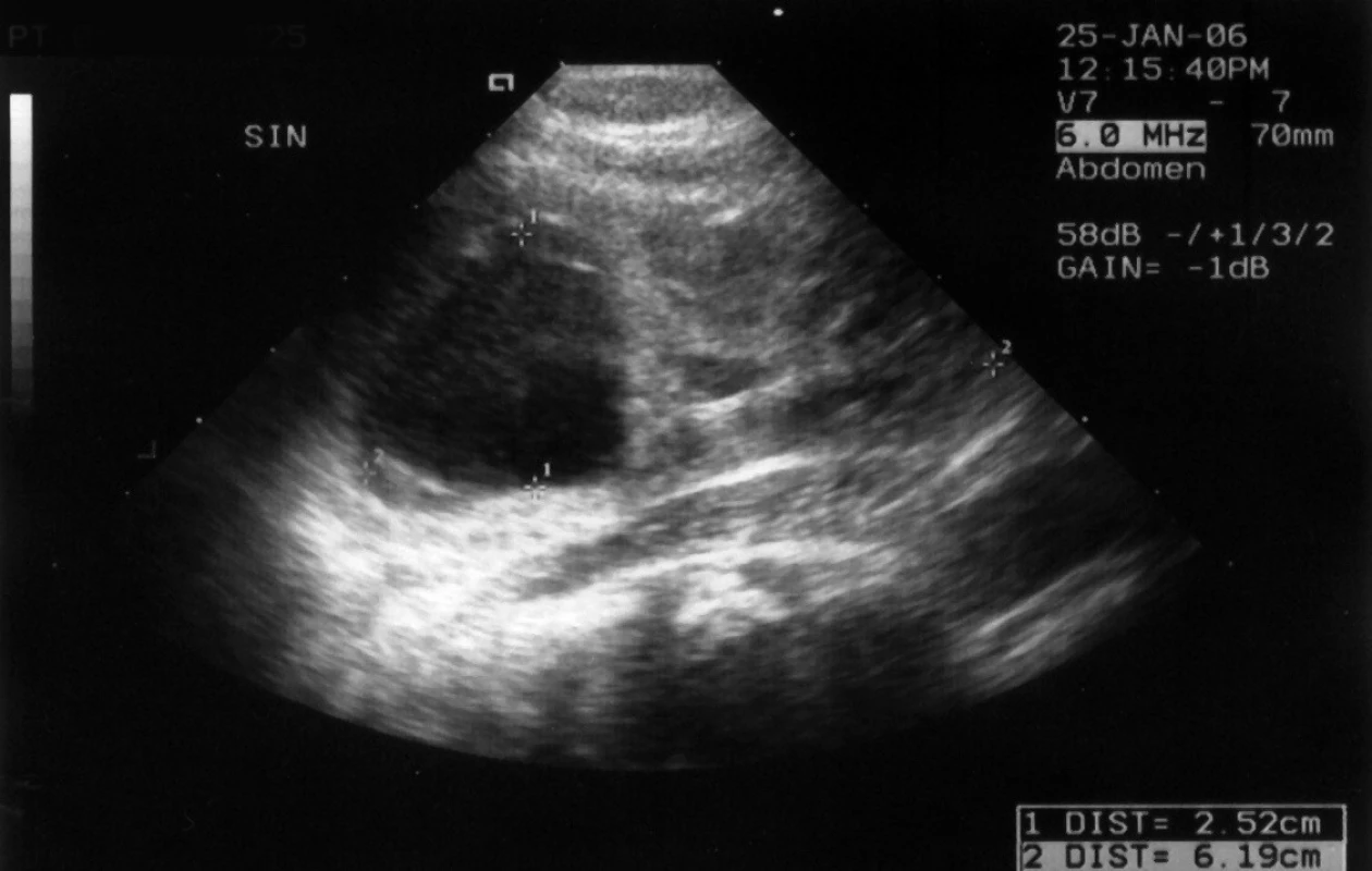 Kazuistika č. 3. UZ levé ledviny s výraznou dilatací horního segmentu, pánvička 32 x 28 mm.
Fig. 5. Case report 3. US of the left kidney with a marked dilatation of the upper segment, pelvis 32 x 38 mm
