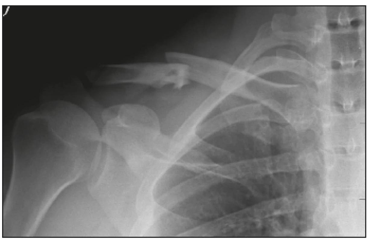 Selhání osteosyntézy