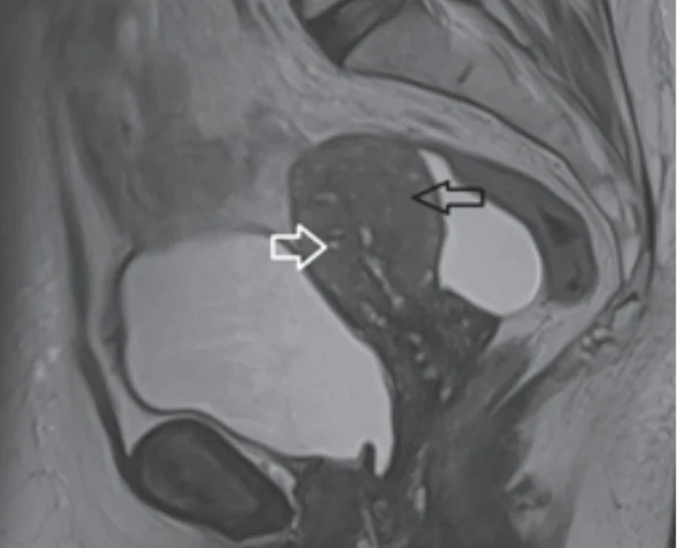 Fig. 2. MRI features of adenomyosis, including hyperintense myometrial foci and junctional zone thickening on sagittal T2-weighted images. Obr. 2. MR znaky adenomyózy, vč. hyperintenzivních myometriálních ložisek a ztluštění junkční zóny na sagitálních T2 vážených snímcích.