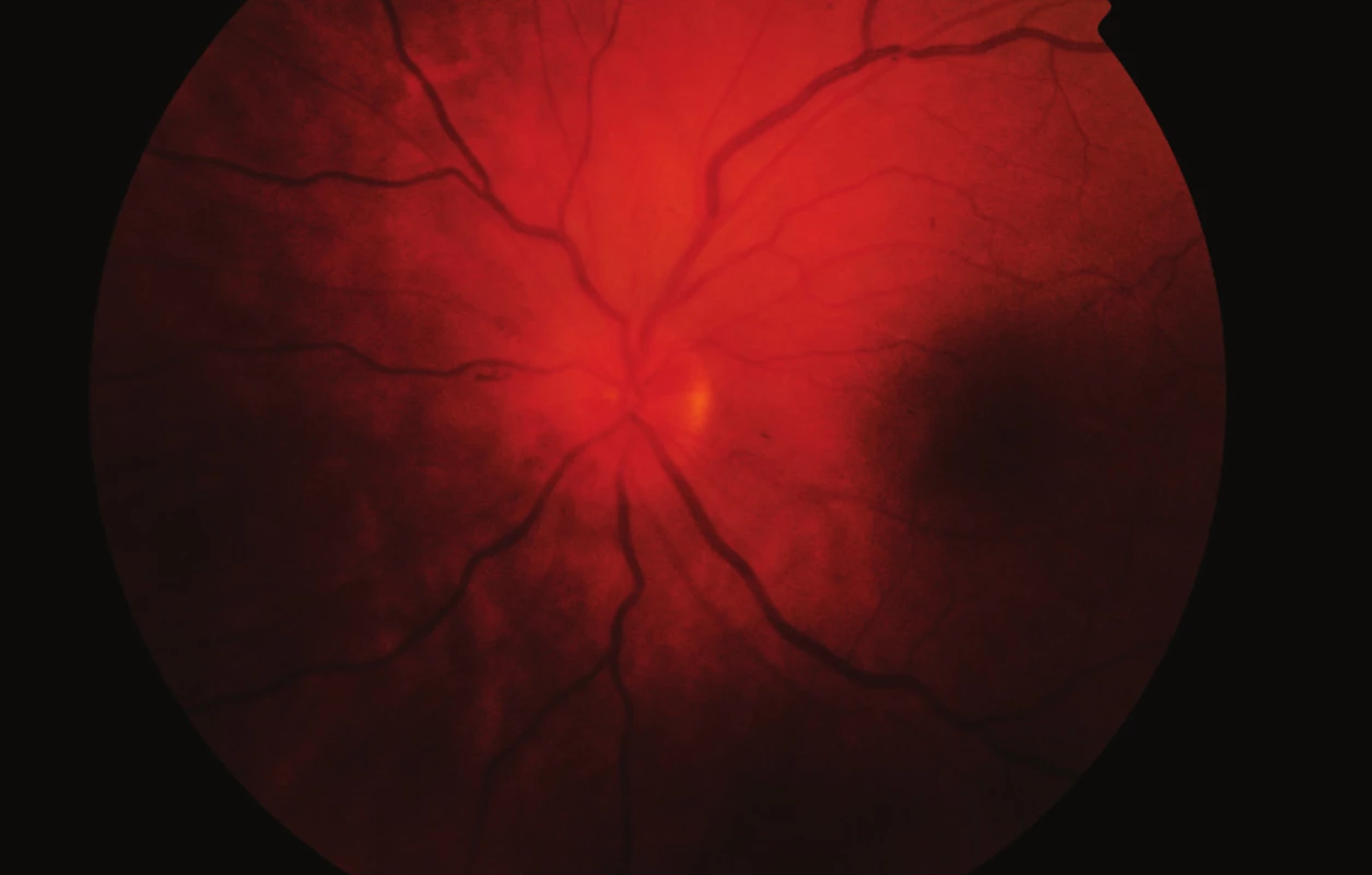 Fundus levého oka při dimisi