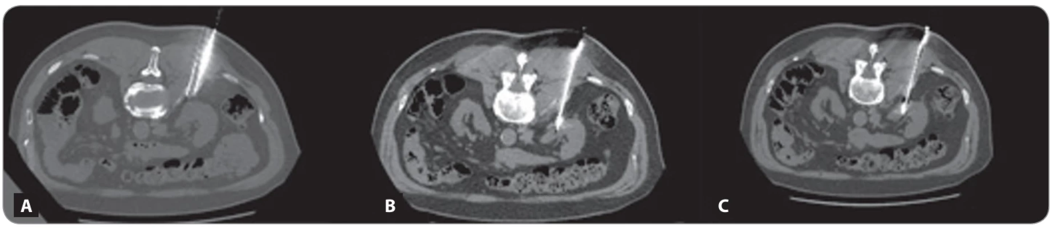 CT axial scan showing the coaxial needle advancement into the retroperitoneal space, between the right psoas muscle and  the right moiety of the kidney, followed by hydrodissection with diluted contrast medium (A); non-contrast axial CT scan showing  the percutaneous access of the microwave probe into the renal cell carcinoma mass (B, C).