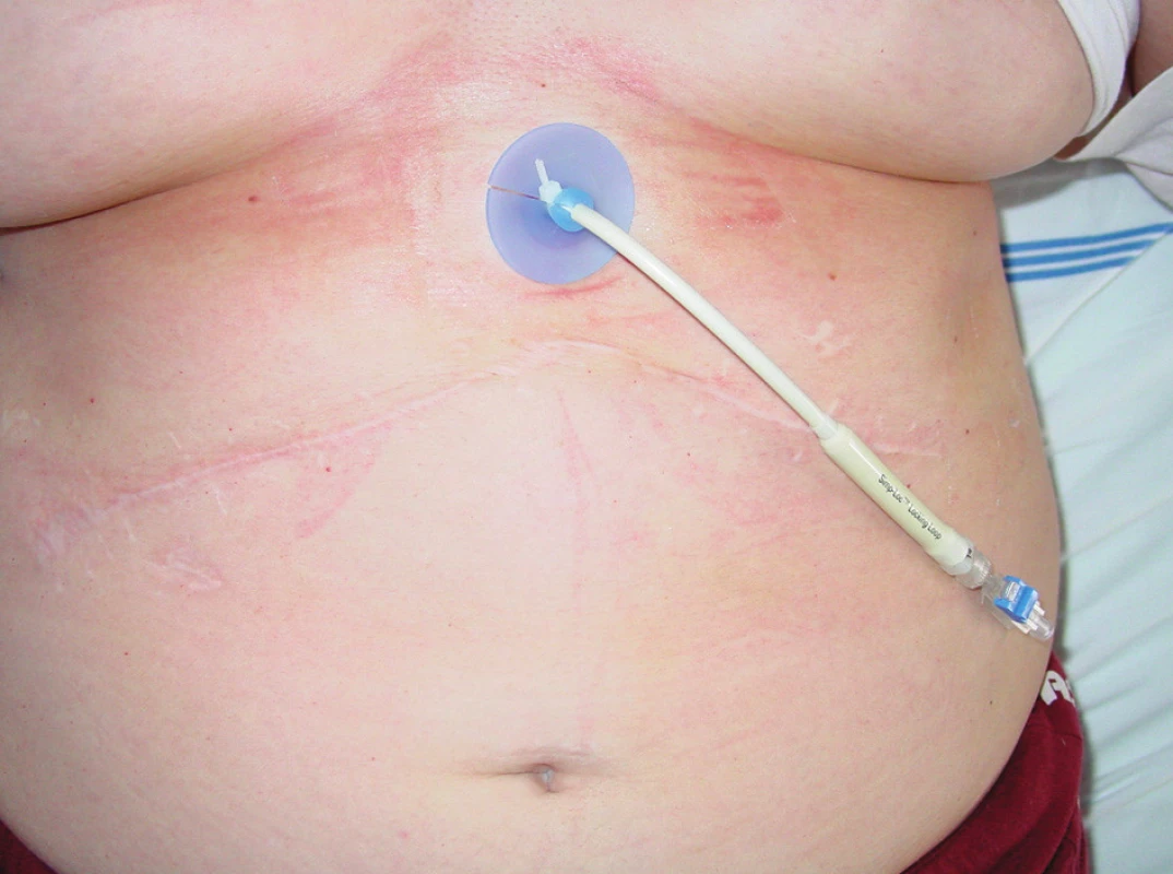 Zevněvnitřní drenáž PTD drénem – levé žlučovody
Fig. 2. PTD (external-internal) drainage – left bile ducts