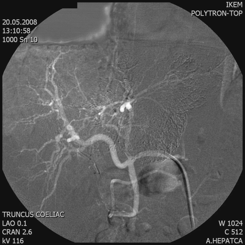 Kontrolní AG a. hepatica – větve zásobující tumor se neplní
Fig. 3. Control AG of the hepatic artery – the branches supplying the tumor do not fill