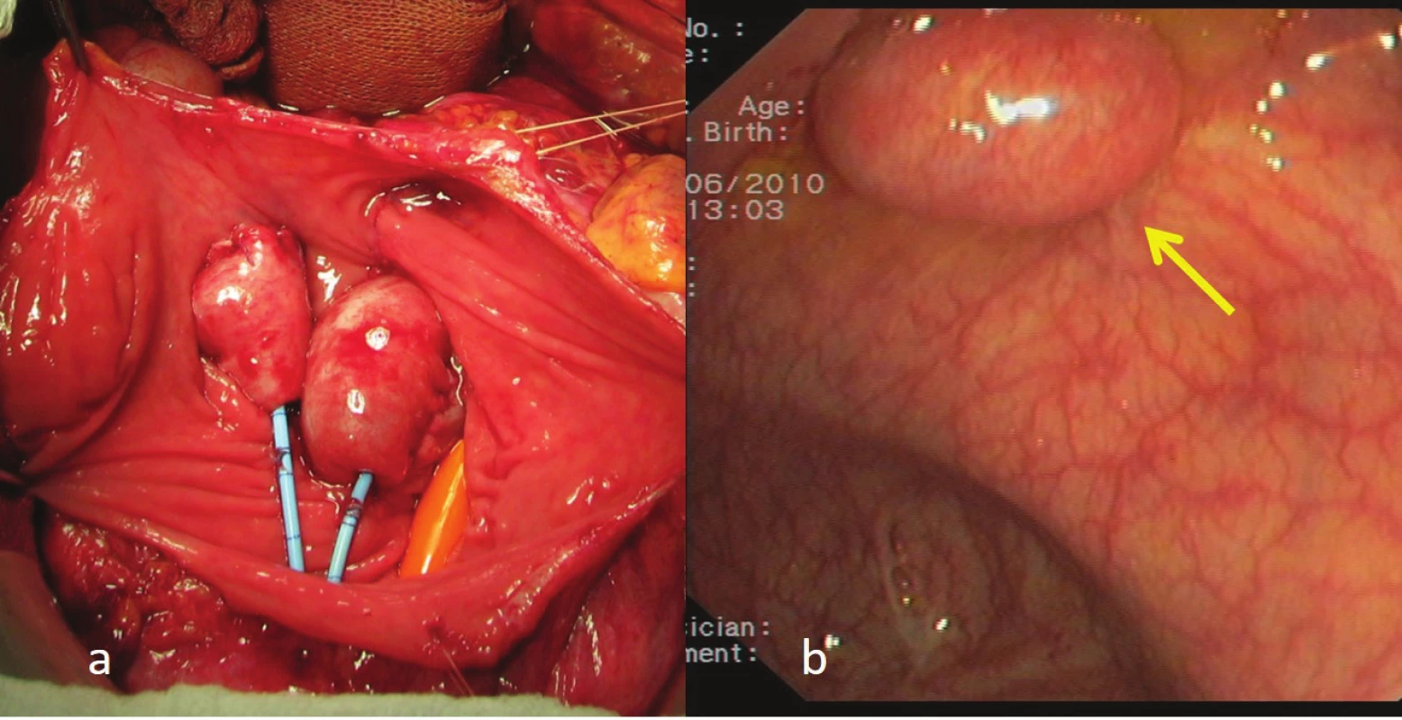 FT – ureterosigmatické anastomózy do sigma-rektum pouche: a) peroperační pohled, b) kolonoskopický pohled 60. měsíc po operaci.
Fig. 8: FT anastomoses to the sigma-rectum pouch: a) peroperation view, b) 60 months after the procedure (colonoscopy)