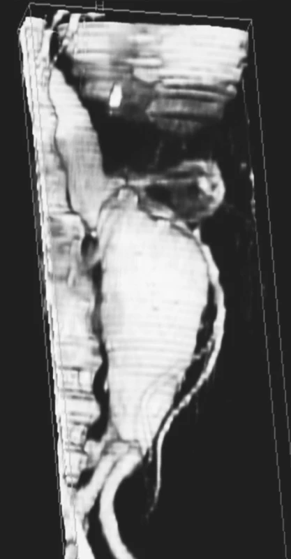 Rekonstrukce velkého juxtarenálního AAA
Fig. 2. Reconstruction of a large juxtarenal AAA