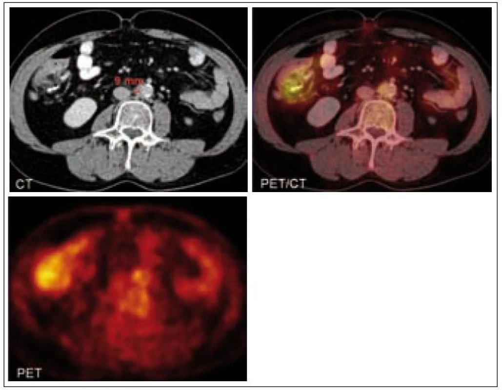 PET/low dose CT. Periaortální infiltrace způsobuje nepravidelné rozšíření stěny aorty a vykazuje ostrůvkovitě vyšší metabolickou aktivitu. Zevní kontury stěny jsou místy zneostřené. Nález je výraznější většinou interaortokaválně, tedy na mediální stěně aorty. Šíře infiltrátu nad bifurkací je až 9 mm, ve zbývajícím úseku břišní aorty jsou změny méně nápadné.