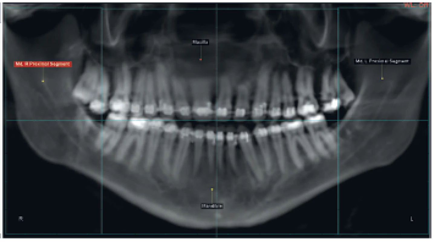OPG generované z CBCT skenu s rozvržením segmentů