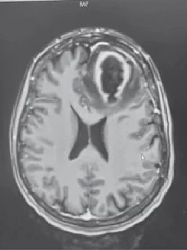 Shows a T1 MRI with a contrast- -enhancing lesion. Obr. 1. Zobrazuje T1 MR s lézí se zesilující kontrastní látkou.