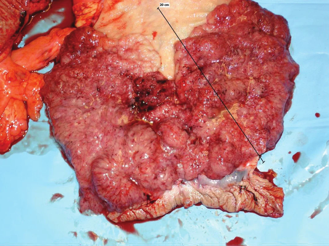 Resekát rekta s polypózou sliznice
Fig. 2: Resecate of the rectum with mucous membrane polyposis
