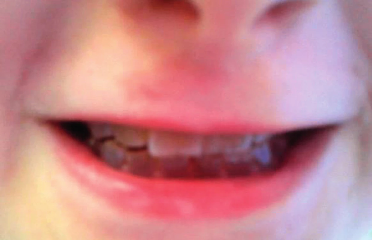 Dentinogenesis imperfecta.
Fig. 4. Dentinogenesis imperfecta.