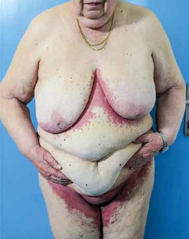 Žena, 74 let, inverzní psoriáza. [Foto: archiv autorky]