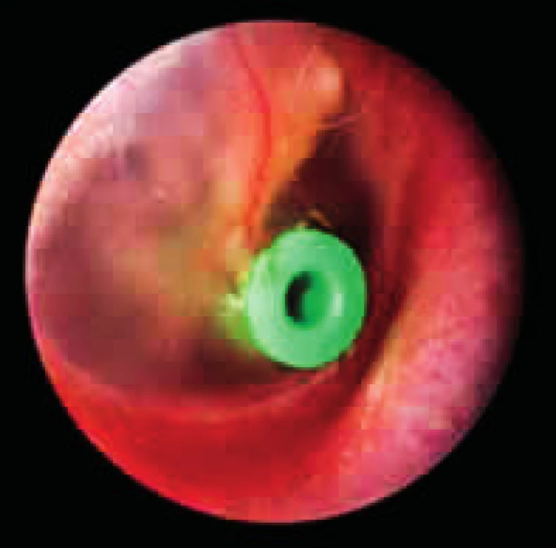 Tlak vyrovnávající trubička v ušním bubínku.
Fig. 4. Ventilation tube in the tympanic membrane.