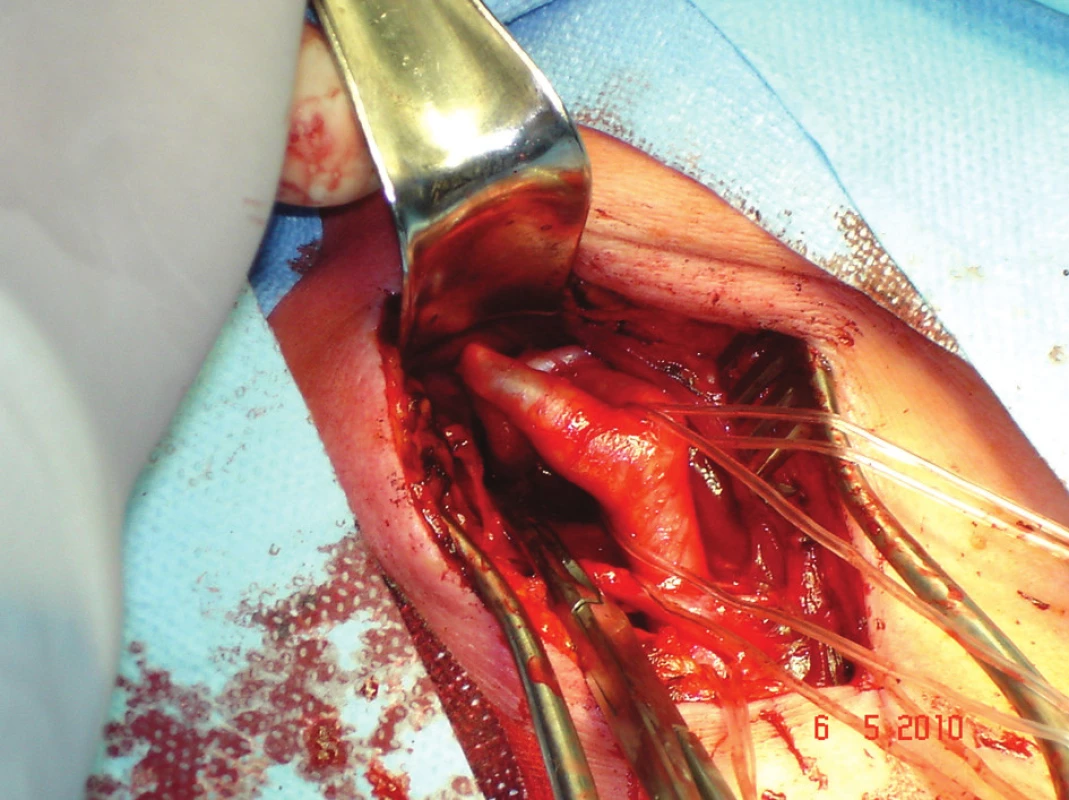 Vypreparovaná bifurkace karotid, na ACI kinking a nad ním naložena cévní svorka
Fig. 1: Prepared carotid bifurcation, the ICA kinking and above it loaded vascular clamp