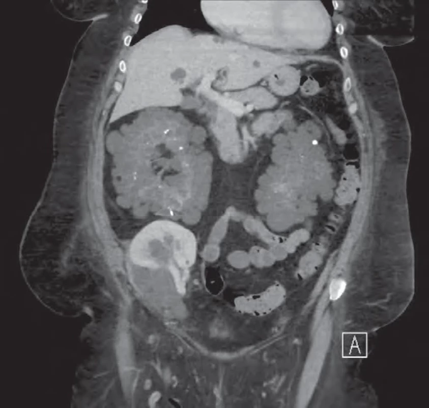 Polycystické ledviny a ledvinový graft v pravé jámě kyčelní. Fig. 2. Polycystic kidney and renal graft in the right iliac fossa.