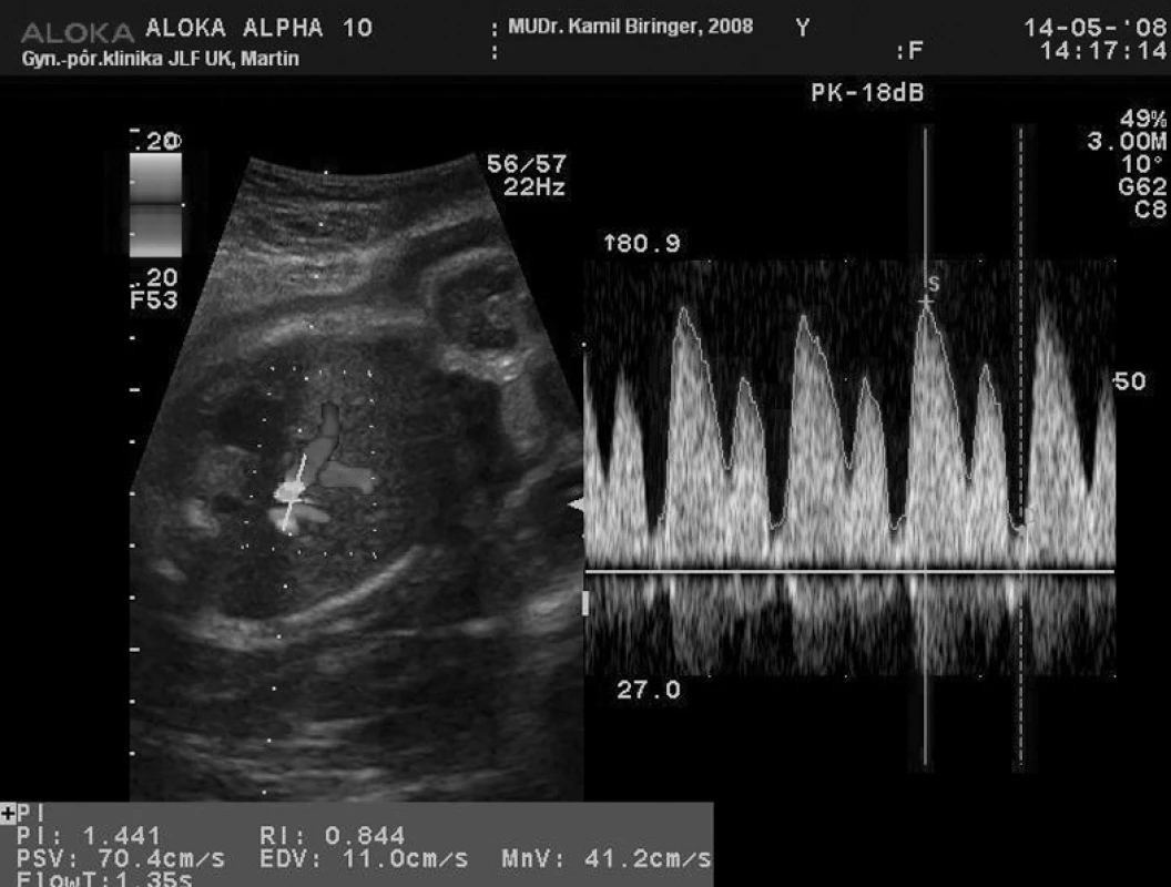 Prietok krvi v ductus venosus