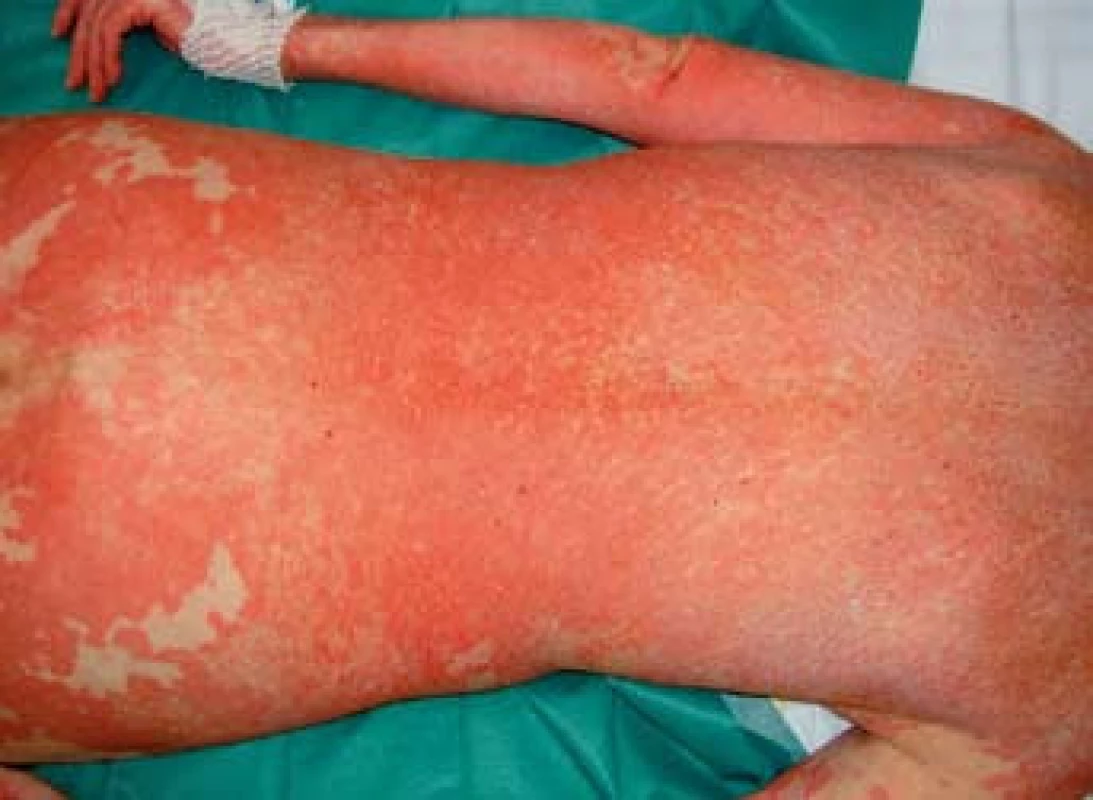 Generalizovaný multiformní exantému trupu.
Fig. 1. Generalized multiform exanthem of the trunk.