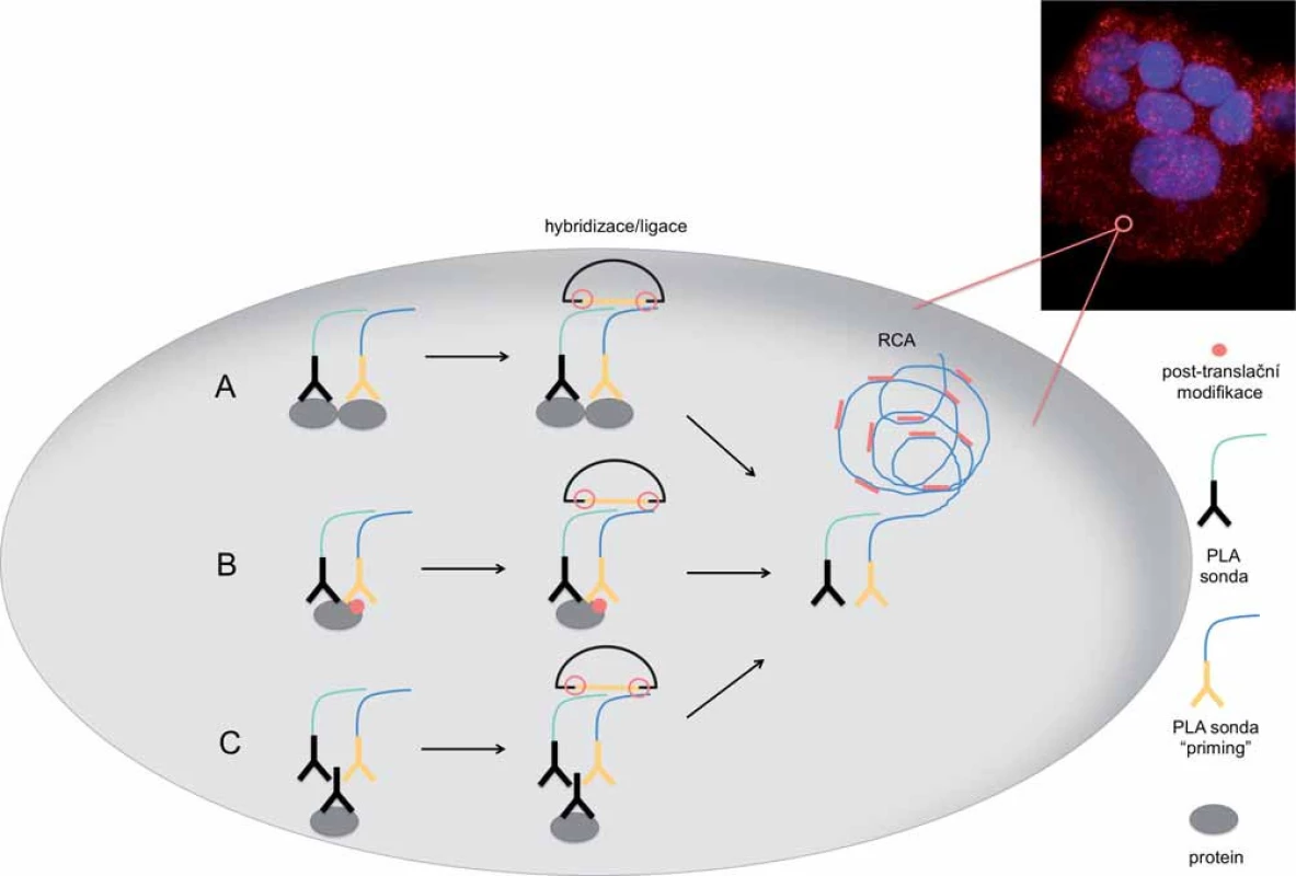 Schéma detekce dimerního proteinového komplexu, post-translační modifikace proteinu a samotného proteinu metodou PLA <em>in situ</em> s využitím amplifikace otáčivou kružnicí (RCA) za vzniku amplifikačního produktu. 
