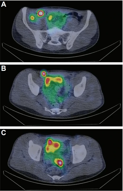SPECT/CT – transverzální řezy se zobrazením ložisek patologické akumulace aktivity = metastázy v oblasti apendixu (A), na peritoneu (B) a v retroperitoneu (C).