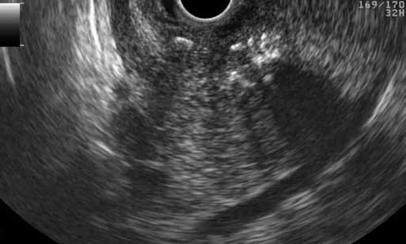 EUS finding of GP: multiple calcifications in the ‚groove‘ and adjacent parenchyma of the pancreatic head (patient 1).
Obr. 3. EUS obraz GP: viacpočetné kalcifikácie v „žliabku“ a naliehajúcom parenchýme hlavy pankreasu (pacient č. 1).