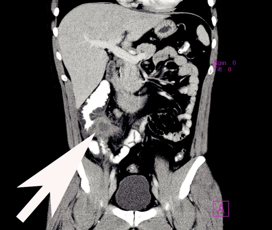 Zánětlivý infiltrát paracékálně po apendektomii
Fig. 4. Inflammatory paracecal infiltration following appendectomy