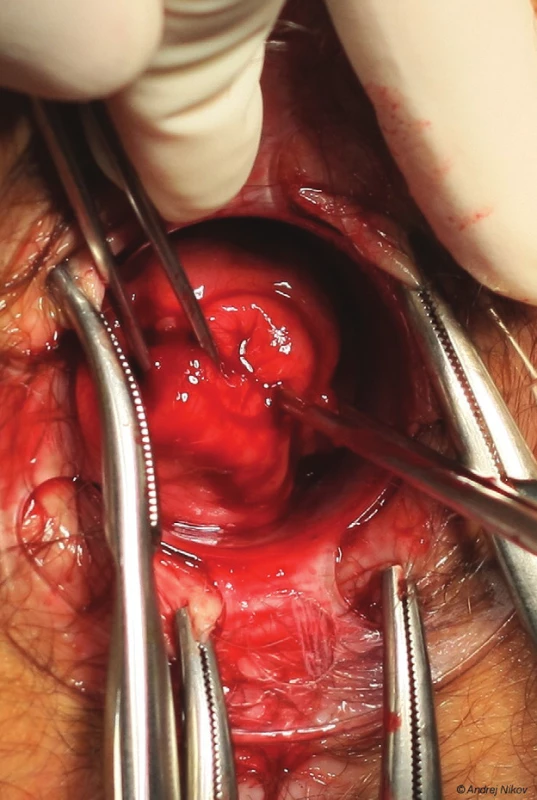 Peroperačný nález stenózy
Fig. 3: Peroperative finding of stenosis