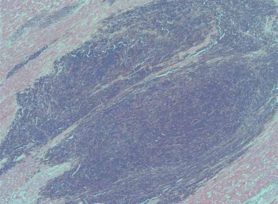 Histologický obraz metastázy malígneho melanómu v myokarde (25-násobné zväčšenie).