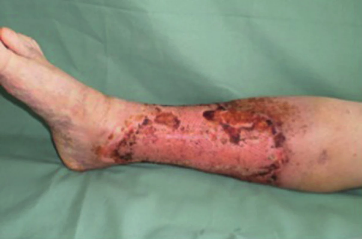 Pacient č. 3 − 15. den po operaci s použitím PRP – kompletně zhojeno
Fig. 3: Patient No. 3 − 15 days after surgery with PRP – wound completely healed