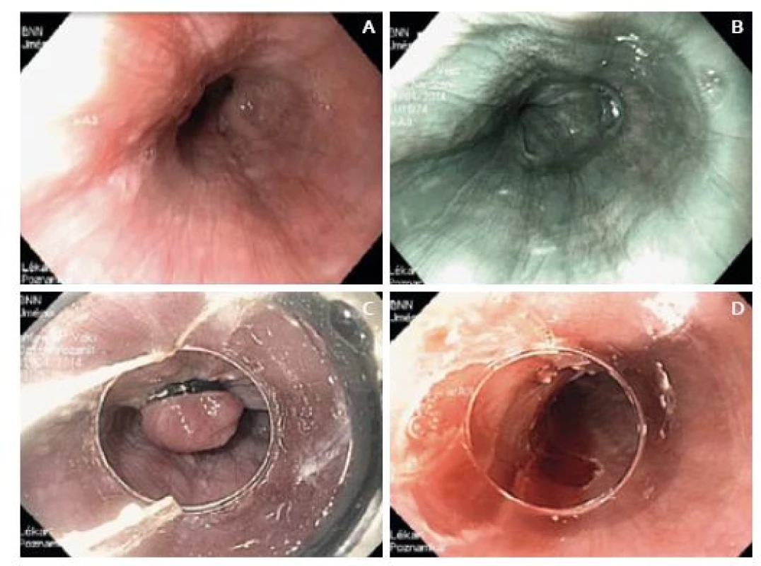 A. Endoskopický obraz v IKEM před resekcí – v bílém světle, B. v NBI, C. endoskopická resekce s použitím ligátoru – EMRL, D. epodina po endoskopické resekci.
Fig. 2. A. Endoscopic image taken at the Institute for Clinical and Experimental Medicine before resection – in white light, B. in NBI, C. endoscopic mucosal resection with ligation – EMRL, D. resected area after endoscopic resection.