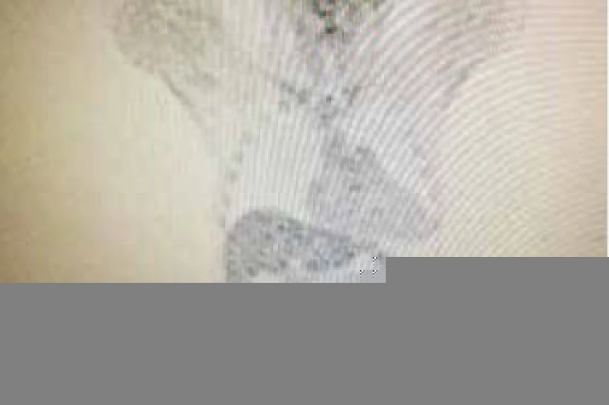 PET-CT vyšetrenie – kontrola po ATB liečbe.
