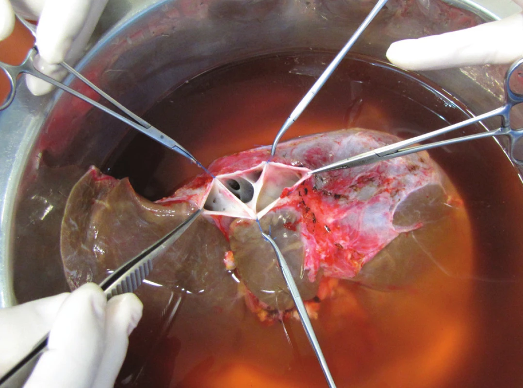 Vyústění jaterních žil do dolní duté žíly na horním okraji jaterního štěpu
Fig. 3. Liver veins entering v. cava inferior near the cephalad edge of the liver graft