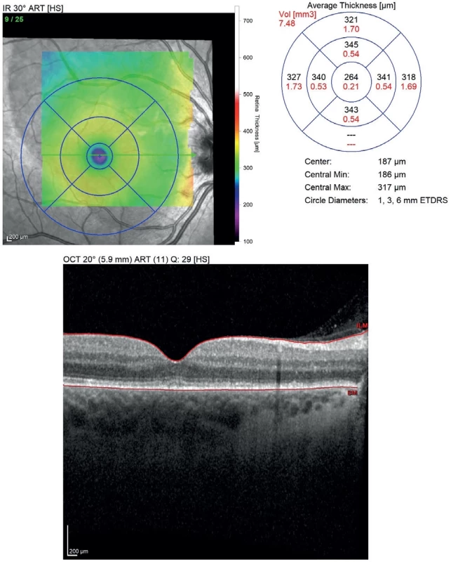 Follow-up OCT scan of the right eye performed one month postpartum. The OCT image demonstrates complete resorption of both subretinal and intraretinal fluid, with restoration of the foveal contour