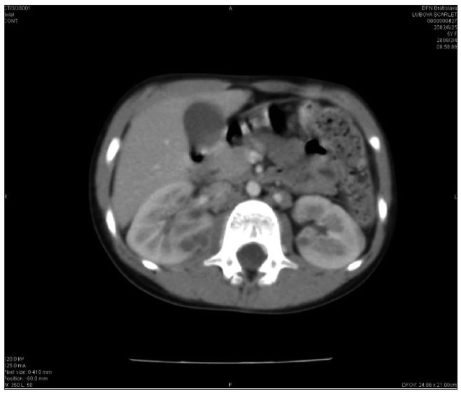 CT vyšetrenie: početné kortikálne a subkapsulárne oválne ložiská obličiek bilaterálne so zväčšenou pravou obličkou.
Fig. 2. CT imaging: numerous bilateral cortical and subcapsular oval foci with enlarged right kidney.