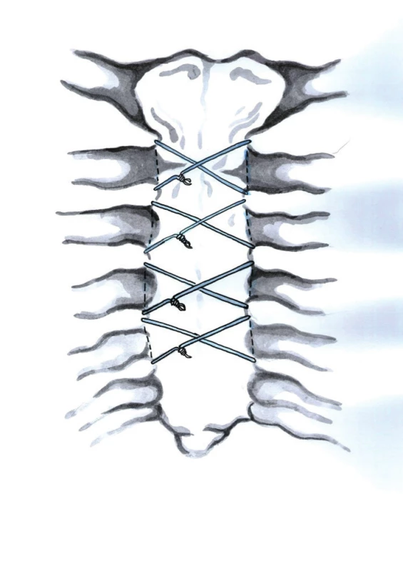 Perikostální drátěné osmičky (Kresba archiv autora)
Fig. 6: Figure-eight pericostal wire closure