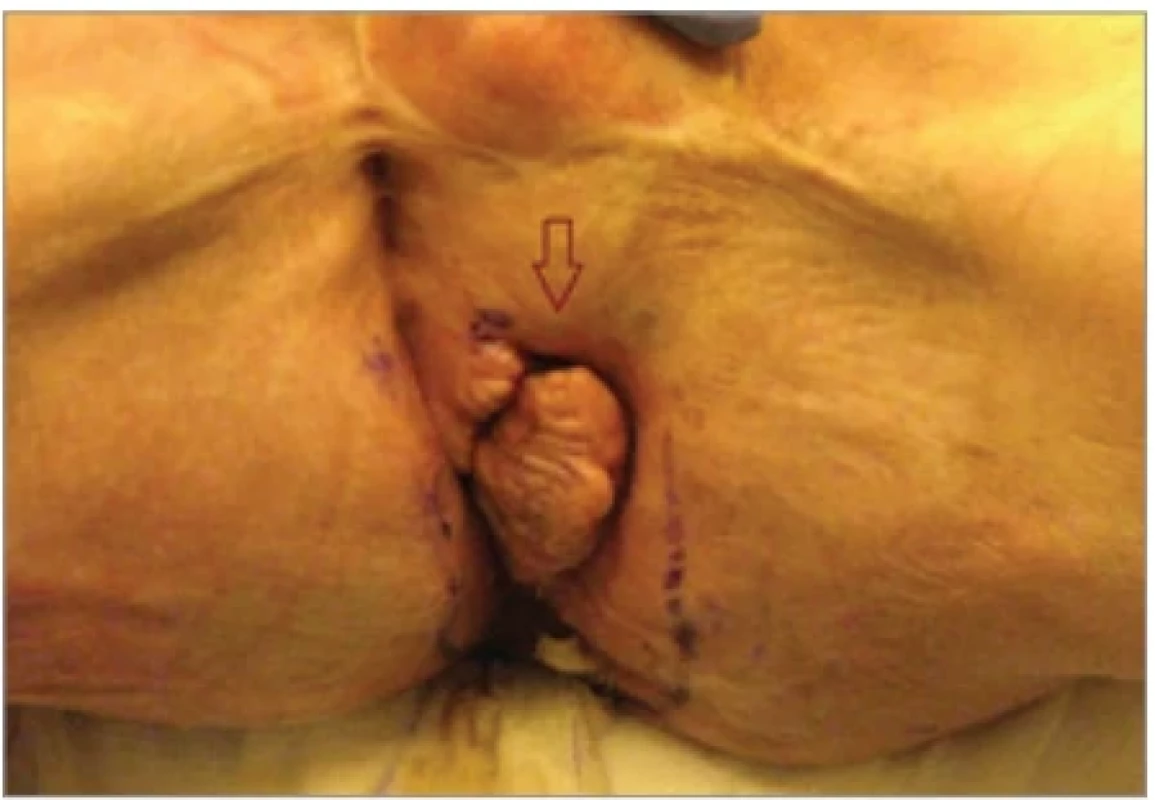 Patient – 1 perineal Hurley III–HS lesions.