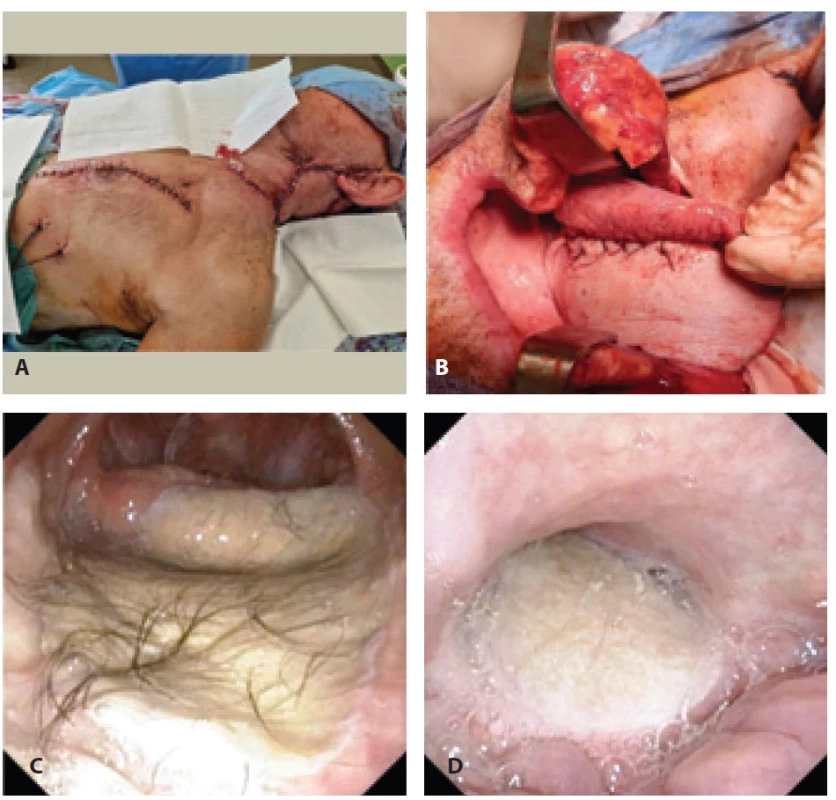 Examples of the pectoralis major myocutaneous fl ap utility in the head and neck reconstruction.