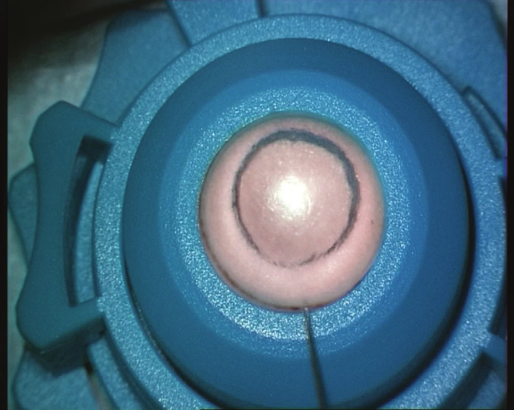 Pneumodisekce (big-bubble)