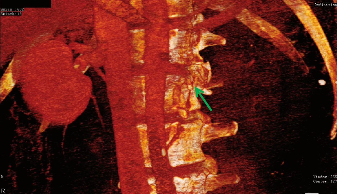 Traumatický uzávěr renální tepny vlevo, řešeno nefrektomií
Fig. 3. Traumatic occlusion of the left renal artery, treated by nephrectomy on the left side
