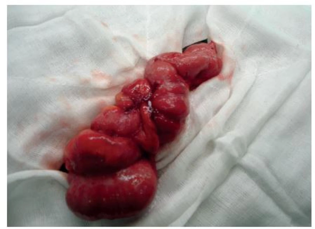 Ileocekální oblast s apendixem, zesílení stěny terminálního ilea
Fig. 1: Ileocaecal region with the appendix, thickened wall of the terminal intestine