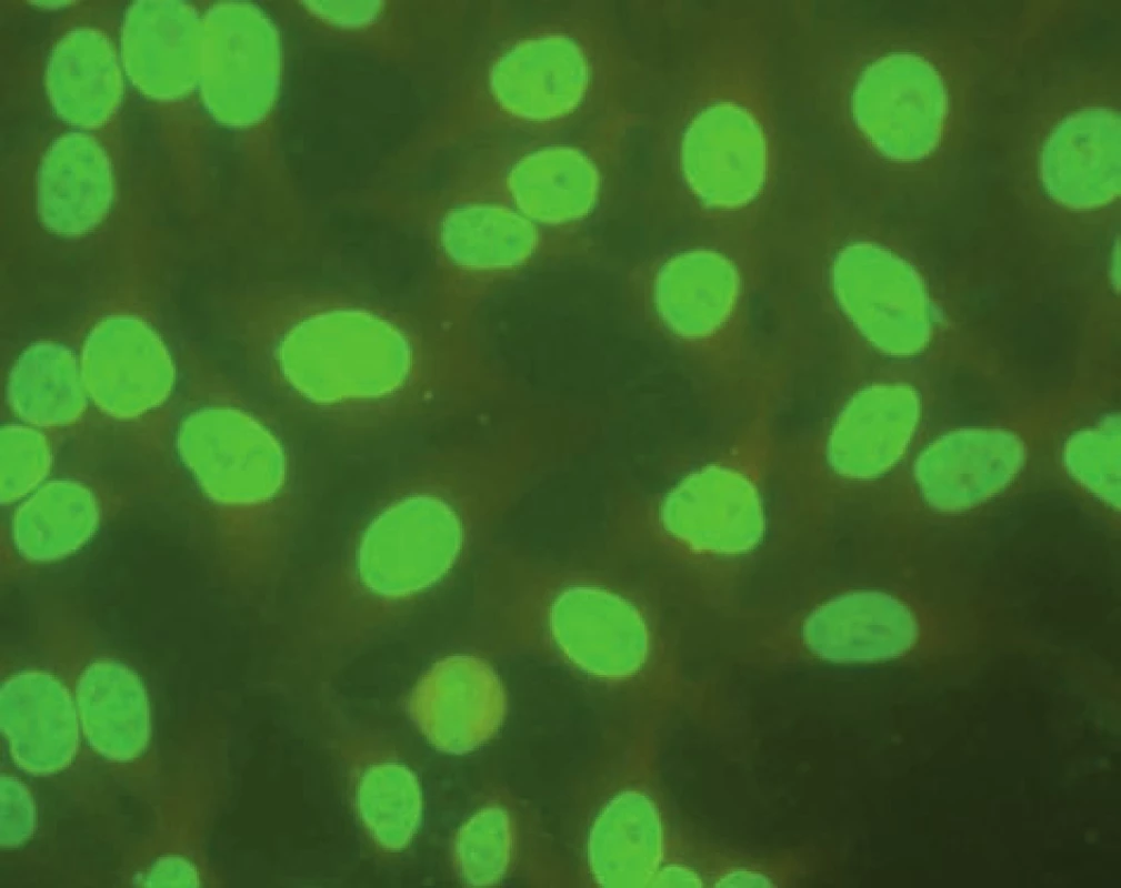 Imunoflourescenční obraz antinukleárních protilátek – homogenní typ (substrát – buněčná linie Hep-2).
Fig. 3. Immunofluorescent image of antinuclear antibodies – homogenous type (substrate – Hep-2 cell line).