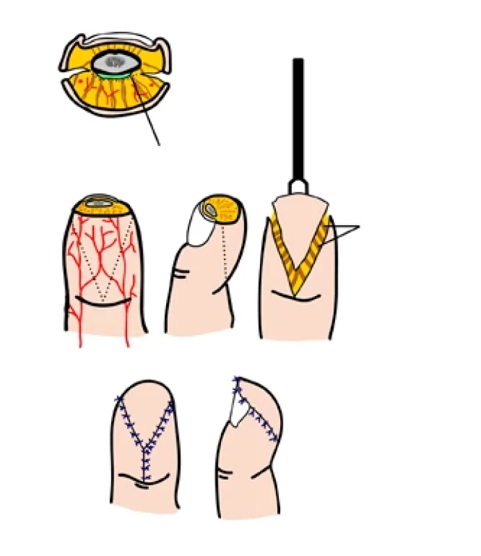 V-Y lalok.