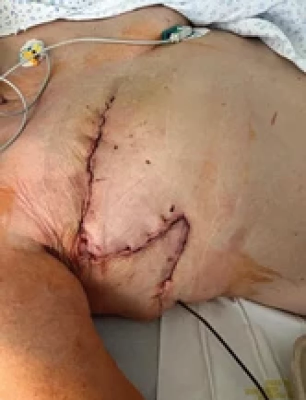 Řešení defektu transpozicí fasciokutánním lalokem. Fig. 5. Reconstruction of the defect using a fasciocutaneous transposition fl ap.