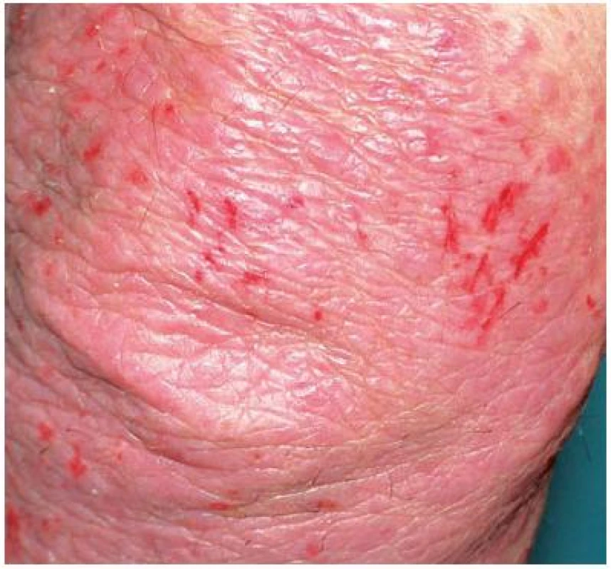 Exkoriace u psoriasis vulgaris