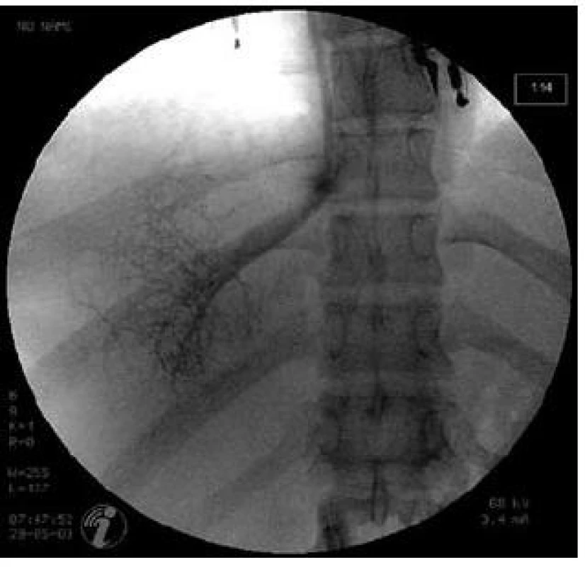 Katetrizace jaterních žil u pacienta s Budd-Chiariho syndromem.
Fig. 5. Hepatic vein catheterization in a patient with Budd-Chiari syndrome.