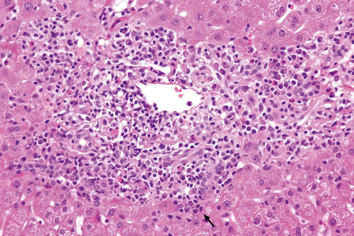 Akutní hepatitida s četnými plazmocyty a eozinofily se středně intenzivní portální (interface a významnou lobulární aktivitou a přemosťujícími nekrózami/centro-centrální, centro-portální), fokálně s krvácením. Známky regenerace jaterního parenchymu, bez fibrózy (interpretace doc. E. Sticová: při odpovídajících klinických a laboratorních parametrech (včetně vyloučení infekce je nález dobře kompatibilní s autoimunitní etiologií), morfologie typická pro AIH, dle simplifikovaných kritérií AIH (hematoxilin eozin zvětšení 400×)