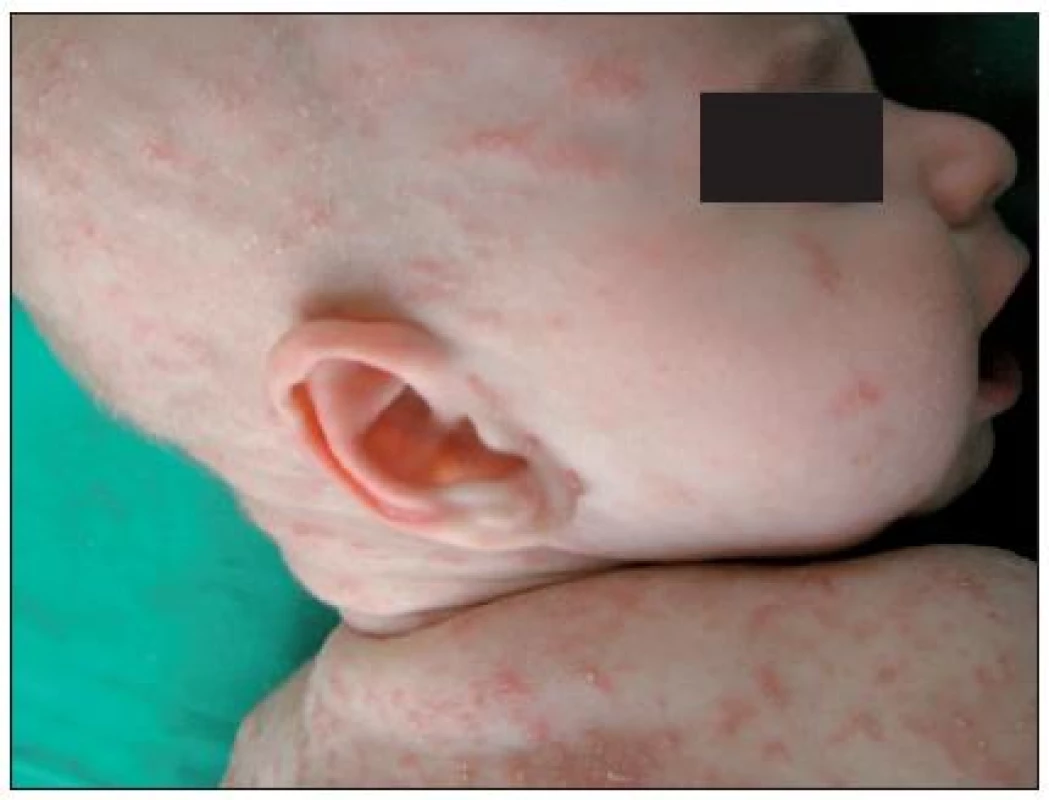 Scabies crustosa postihnutie hlavy (Danilla T.)