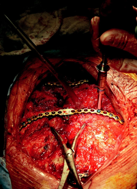 Implantace dlah – zavedení a dotažení šroubů.