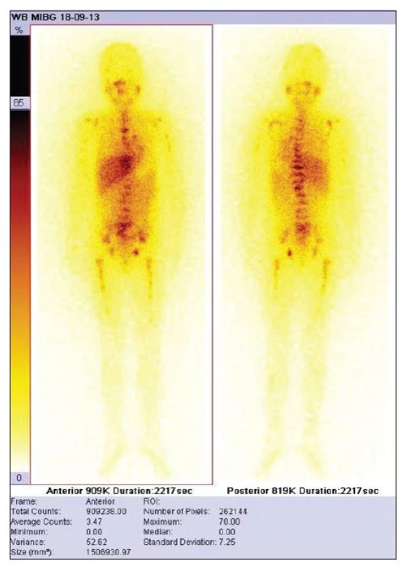 Vhodný pacient pro výpočet TMRR – pacient vhodný pro výpočet celkového retenčního skóre – difuzní metastatické postižení skeletu.