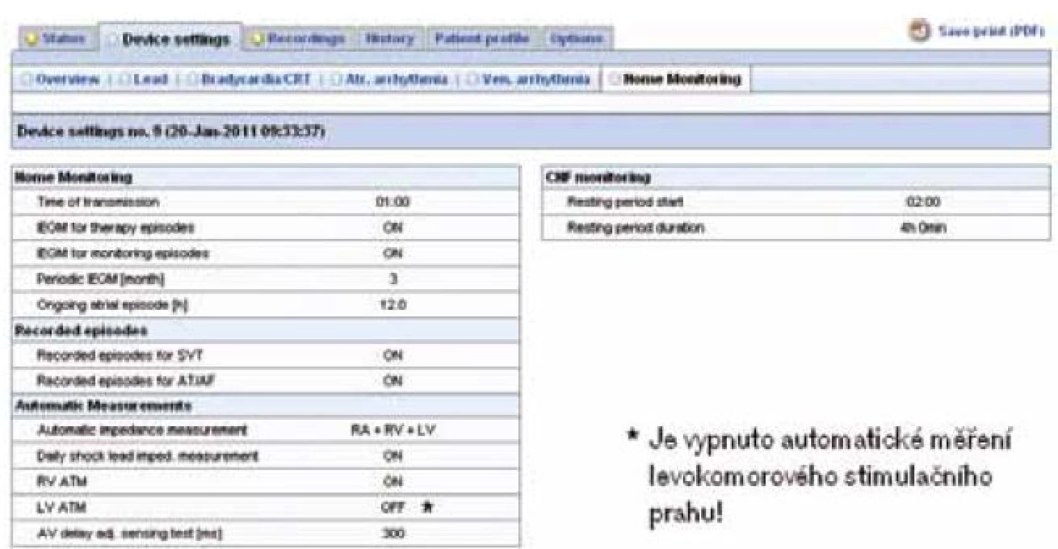 Programace implantátu – biventrikulárního defibrilátoru Lumax 540 HF-T (parametrů týkajících se HM) zobrazitelná v systému Home Monitoring. V „trendových“ datech jsou zobrazeny informace o aktuálním programování implantátu. U tohoto pacienta jsou data odesílána v 1.00 hod, od všech epizod je přenášen intrakardiální elektrogram (IEGM), periodické IEGM je odesíláno každé 3 měsíce, je zapnuto automatické měření impedance na všech elektrodách, automatické měření pravokomorového prahu, je vypnuté automatické měření levokomorového prahu. Pro hodnocení klidové tepové frekvence se využívá doba od 2.00 hod v noci po dobu 4 hod.