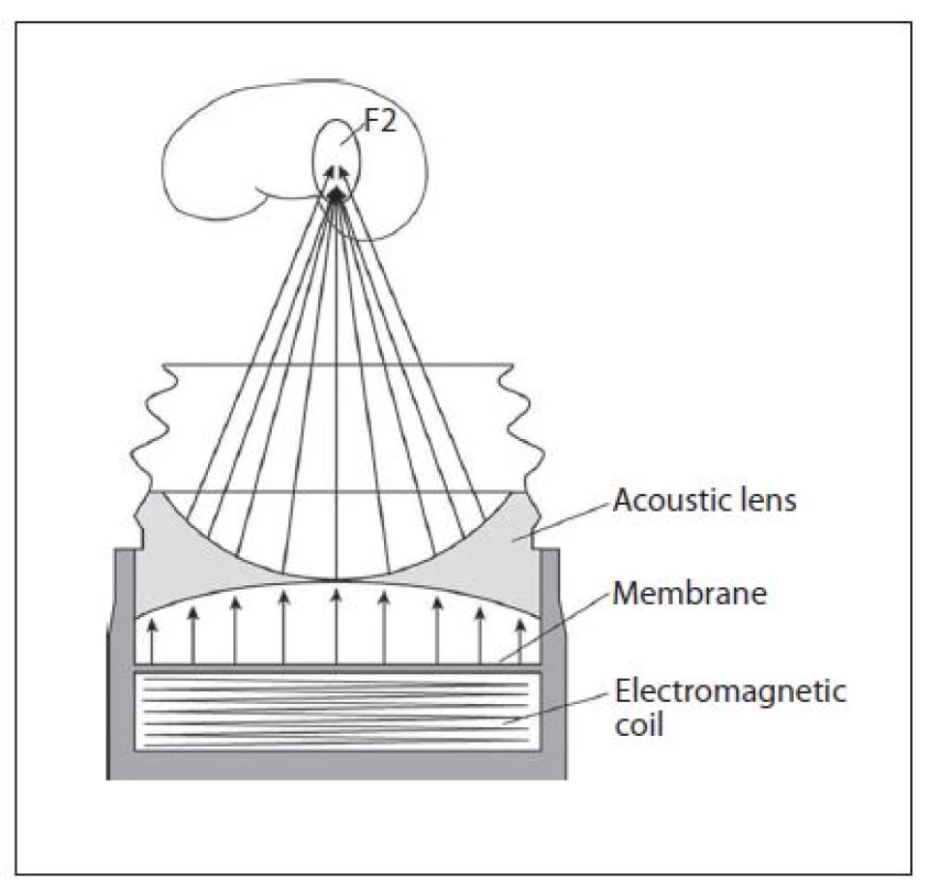 Princip vzniku a usměrnění výboje akustickou čočkou u magnetického generátoru
Fig. 7. Principle and spark aiming by acoustic lens of a magnetic generator