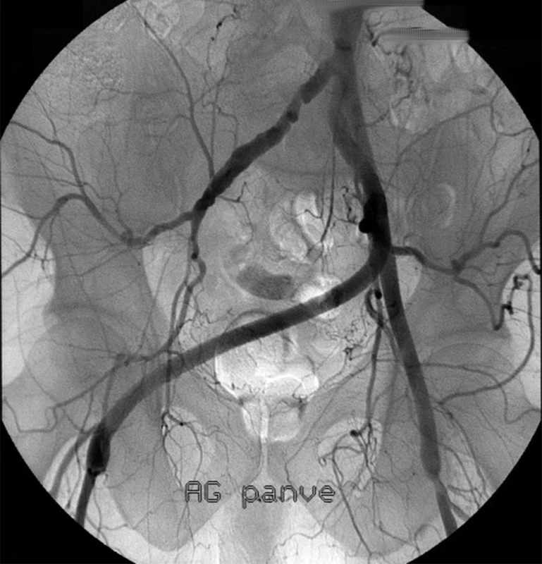 Angiografie potvrzující průchodnost aortofemorálního bypassu vlevo a levopravého zkříženého bypassu na femorální tepnu vpravo
Fig. 2. Angiography confirming patency of the left aortofemoral bypass and the left-to-right crossover bypass to the right femoral artery